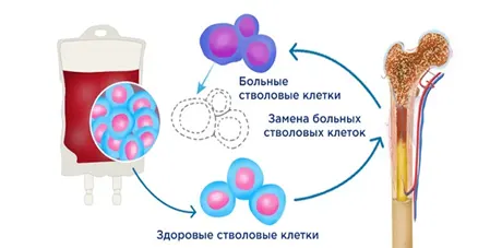 Трансплантация гемопоэтических стволовых клеток (ТГСК) 