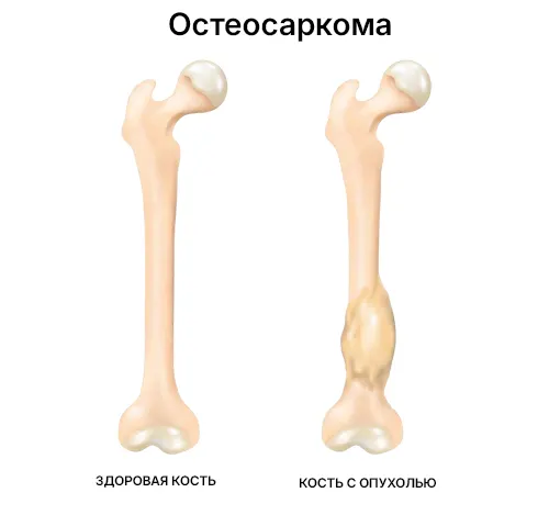 Остеосаркома